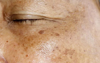 你不知道的祛斑消痘印小竅門，方便又省錢