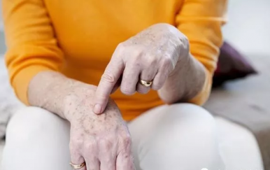 皮膚長(zhǎng)老年斑怎么去掉，學(xué)會(huì)4招“吃”掉老年斑