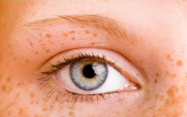 女人黃褐斑是怎么形成的？主要與這幾大因素有關(guān)