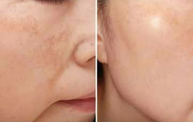 都說祛斑難，對不起，那是他因為你沒選對方法！